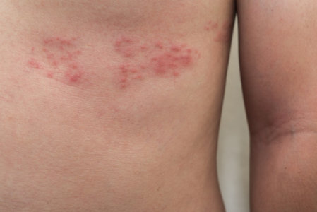 Things You Should Know About the Shingles