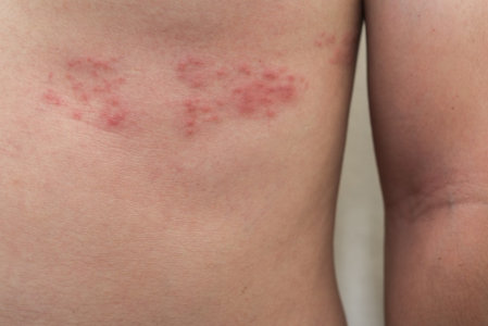 Things You Should Know About the Shingles